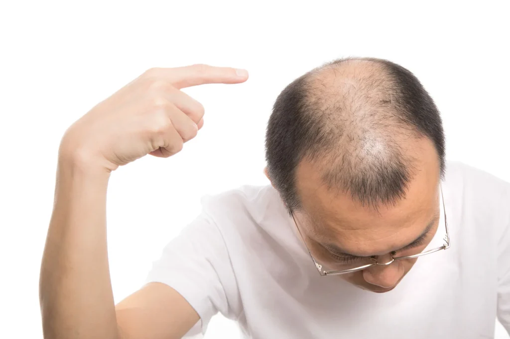 AGA治療効果が早い人の特徴3選！治療効果は「半年〜1年」から実感！